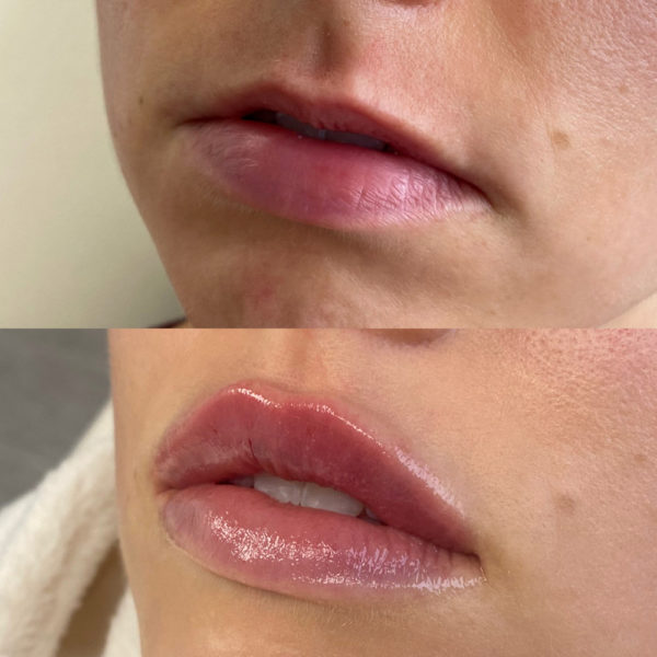 Dermal Fillers in Bloomfield Hills, MI | Beauty Culture Med Spa